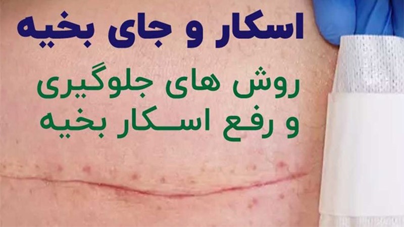 ترمیم جای زخم و بخیه