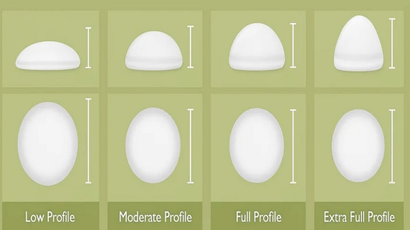 انواع پروفایل پروتز