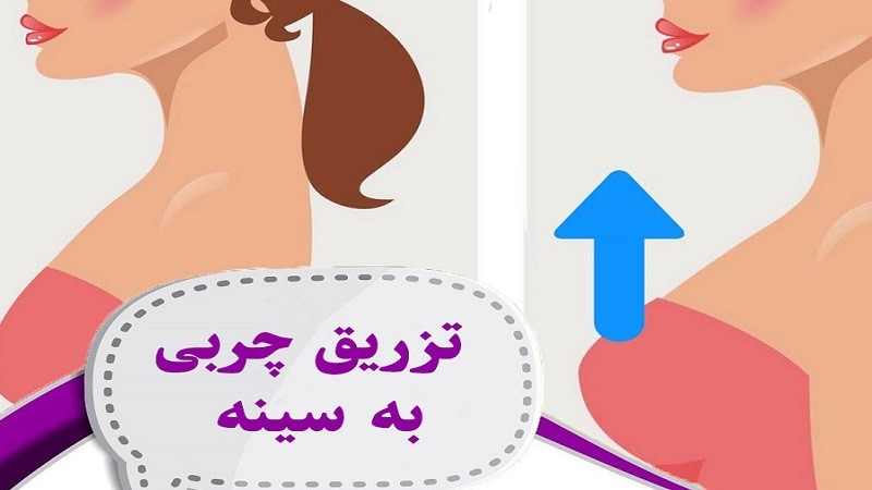 بازسازی فرم سینه با تزریق چربی