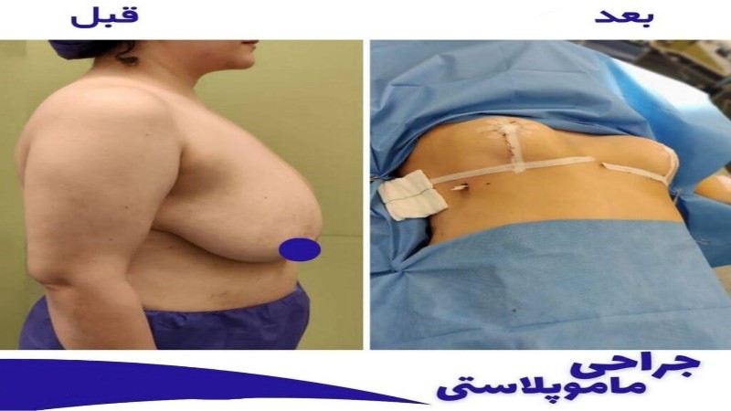 جراحی ماموپلاستی