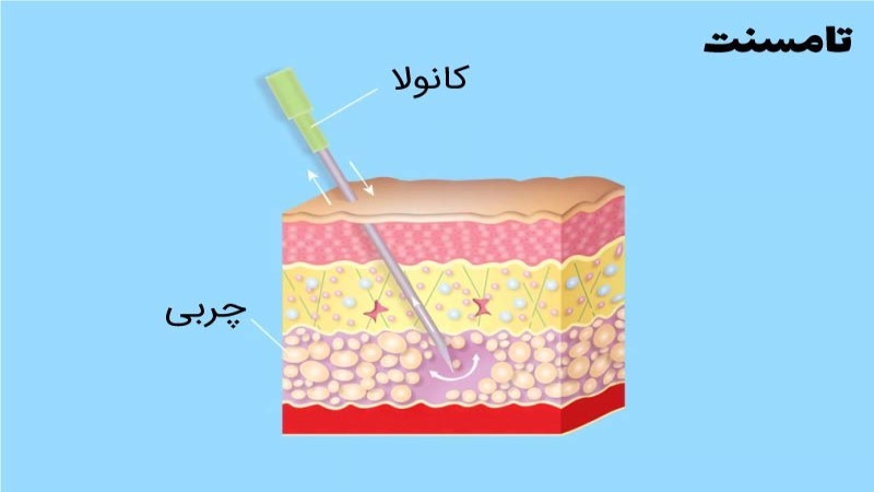 لیپوساکشن تامسنت