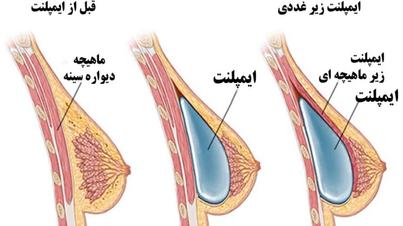 ماموپلاستی افزایشی