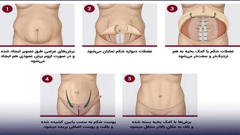 مراحل انجام ابدومینوپلاستی