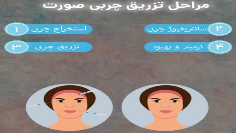 مراحل تزریق چربی به صورت