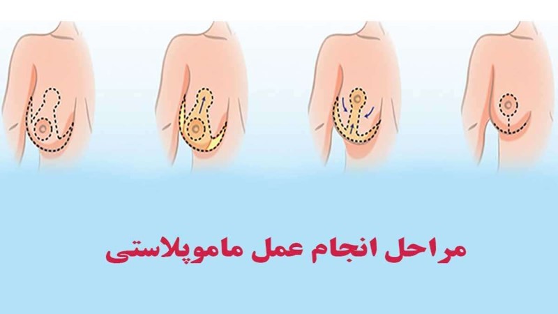 مراحل جراحی ماموپلاستی