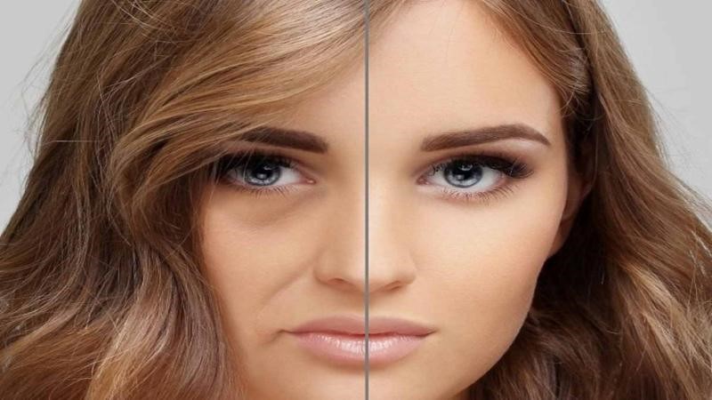 نتیجه تزریق چربی به صورت